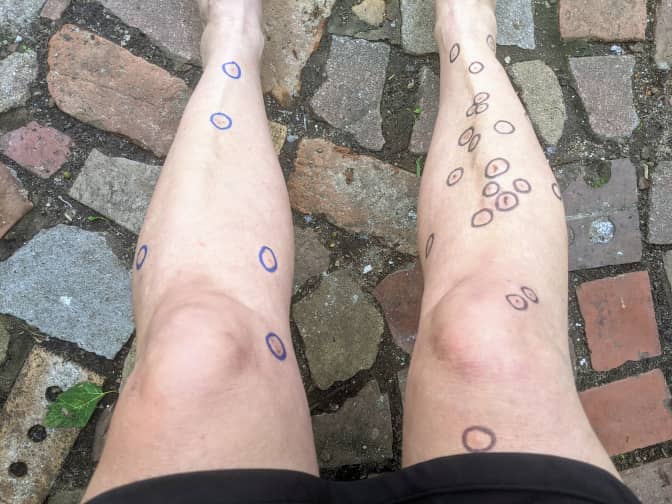 Photo of legs with mosquito bites circled with black marker